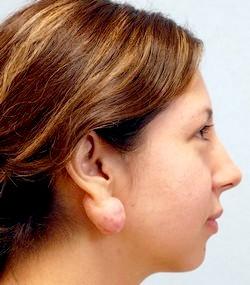 Before Results for Earlobe Repair, Keloid Removal, Scar Revision